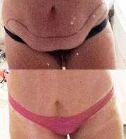 Tummy tuck surgery covered by insurance