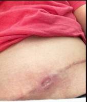 Tummy tuck surgery incision problems