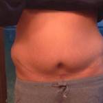 Tummy tuck surgery pictures after 2 years