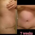 Tummy tuck surgery pictures after 7 weeks
