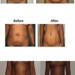Tummy tuck surgery pictures before and after