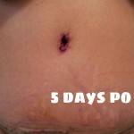 Tummy tuck surgery pictures in 5 days