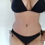 Tummy tuck surgery pictures photo