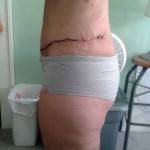 Tummy tuck surgery pictures recovery