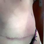 Tummy tuck surgery pictures scar