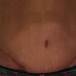 Tummy tuck surgery pictures scar after tummy tuck