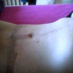 Tummy tuck surgery pictures strips