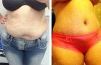 Tummy tuck what to expect before and after