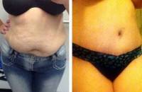 Tummy tuck what to expect photos