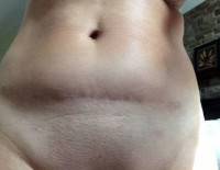 Tummy tuck with c-section delivery photos