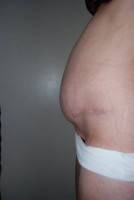 Tummy tuck with c-section delivery picture