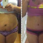 Tummy tuck with herna repair and lipo before and after