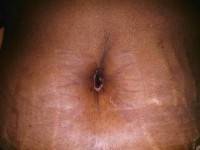 Tummy tuck with hysterectomy belly button