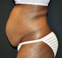 Tummy tuck with hysterectomy surgery