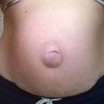 Tummy tuck with umbilical hernia repair belly button