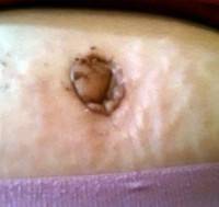 Ugly belly button after tummy tuck surgery