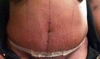 Vertical incision tummy tuck image