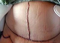 Vertical incision tummy tuck photo
