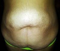 Vertical scar tummy tuck image