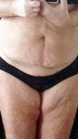 Vertical scar tummy tuck picture