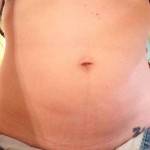 What is tummy tuck surgery photo
