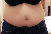 Whats a tummy tuck question