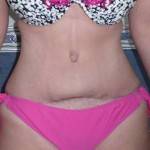 A Tummy tuck with liposuction before and after