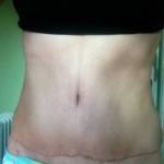 Abdominoplasty photos of tummy tuck scars