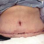 Abdominoplasty results pictures