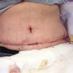 Abdominoplasty tummy tuck results pictures after operation