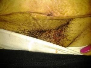 Bad Tummy Tuck surgery
