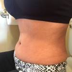 Before and after abdominoplasty