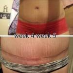 Before and after tummy tuck (10)