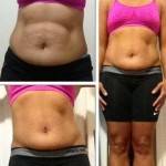 Before and after tummy tuck (2)