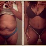 Before and after tummy tuck (3)
