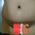 Before and after tummy tuck (4)