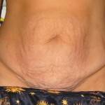 Before and after tummy tuck (51)
