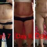 Before and after tummy tuck (6)