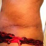 Before and after tummy tuck (65)