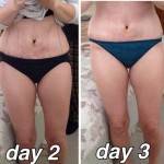 Before and after tummy tuck (81)