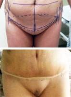 Before and after tummy tuck image patient