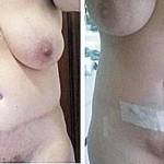 Before and after tummy tuck images