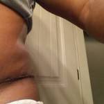 Before and after tummy tuck keloid scar