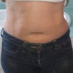 Before and after tummy tuck of belly button