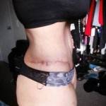 Before and after tummy tuck photo scar