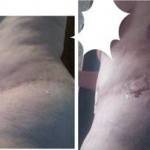 Before and after tummy tuck picture