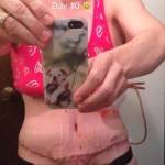 Before and after tummy tuck picture of drains
