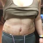 Before and after tummy tuck recovery photo