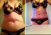 Loose skin after tummy tuck surgery