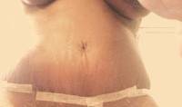 Low scar tummy tuck picture